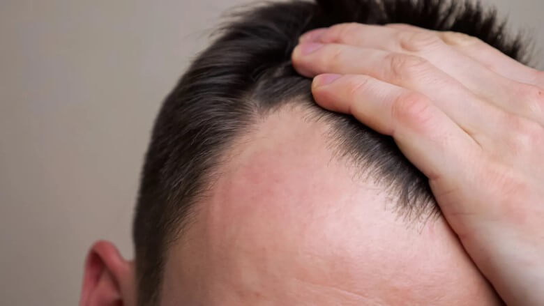 Saisonaler Haarausfall - Was kannst Du als Mann dagegen tun?
